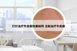 打針治療牛皮癬效果如何 注射治療牛皮癬