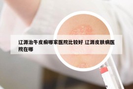 遼源治牛皮癬哪家醫(yī)院比較好 遼源皮膚病醫(yī)院在哪