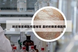 附近銀屑病醫(yī)院是哪家 最好的銀屑病醫(yī)院