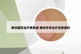 廊坊醫(yī)院治療銀屑病 廊坊市有治療皮膚病的