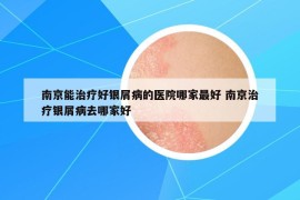 南京能治療好銀屑病的醫(yī)院哪家最好 南京治療銀屑病去哪家好