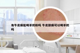 有牛皮癬能喝羊奶粉嗎 牛皮膚癬可以喝羊奶嗎