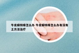 牛皮癬特癢怎么辦 牛皮癬特癢怎么辦有沒有土方法治療