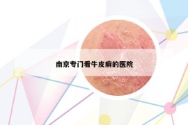 南京專門(mén)看牛皮癬的醫(yī)院