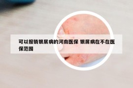 可以報銷銀屑病的河南醫(yī)保 銀屑病在不在醫(yī)保范圍