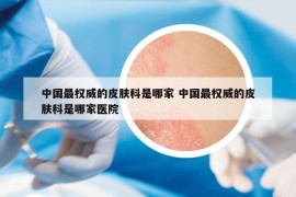 中國(guó)最權(quán)威的皮膚科是哪家 中國(guó)最權(quán)威的皮膚科是哪家醫(yī)院