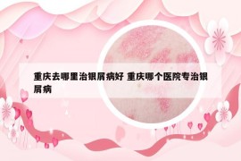 重慶去哪里治銀屑病好 重慶哪個(gè)醫(yī)院專治銀屑病