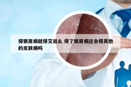 得銀屑病就得艾滋么 得了銀屑病還會(huì)得其他的皮膚病嗎