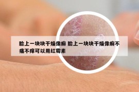 臉上一塊塊干燥像癬 臉上一塊塊干燥像癬不痛不癢可以用紅霉素