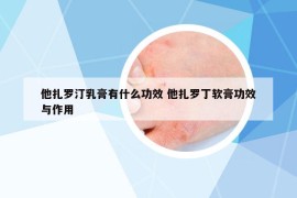他扎羅汀乳膏有什么功效 他扎羅丁軟膏功效與作用