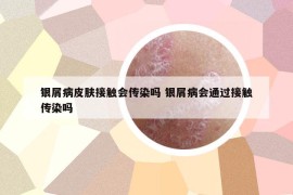 銀屑病皮膚接觸會傳染嗎 銀屑病會通過接觸傳染嗎