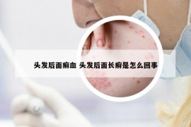 頭發(fā)后面癬血 頭發(fā)后面長癬是怎么回事
