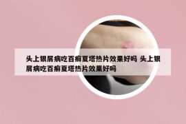 頭上銀屑病吃百癬夏塔熱片效果好嗎 頭上銀屑病吃百癬夏塔熱片效果好嗎