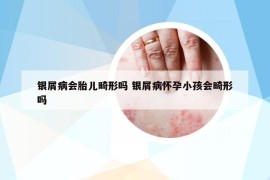 銀屑病會胎兒畸形嗎 銀屑病懷孕小孩會畸形嗎