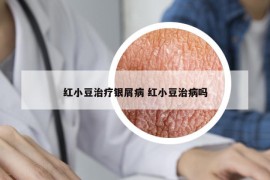 紅小豆治療銀屑病 紅小豆治病嗎