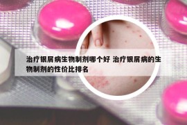治療銀屑病生物制劑哪個好 治療銀屑病的生物制劑的性價比排名