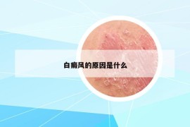 白癜風的原因是什么