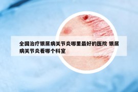 全國治療銀屑病關(guān)節(jié)炎哪里最好的醫(yī)院 銀屑病關(guān)節(jié)炎看哪個(gè)科室