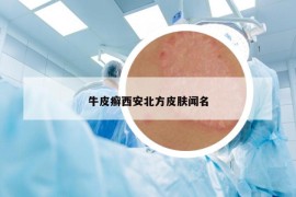 牛皮癬西安北方皮膚聞名