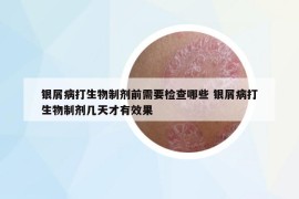 銀屑病打生物制劑前需要檢查哪些 銀屑病打生物制劑幾天才有效果