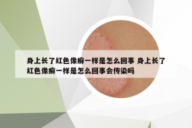 身上長了紅色像癬一樣是怎么回事 身上長了紅色像癬一樣是怎么回事會傳染嗎