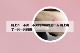 腿上長一小片一小片的像癬的是什么 腿上出了一片一片的癬