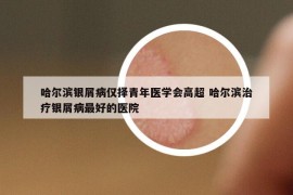 哈爾濱銀屑病僅擇青年醫(yī)學(xué)會(huì)高超 哈爾濱治療銀屑病最好的醫(yī)院