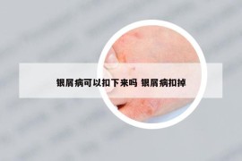 銀屑病可以扣下來(lái)嗎 銀屑病扣掉