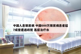 中國(guó)人患銀屑病 中國(guó)600萬(wàn)銀屑病患者超7成曾遭遇歧視 基層治療水