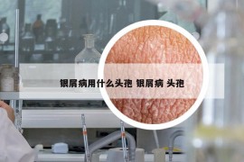 銀屑病用什么頭孢 銀屑病 頭孢