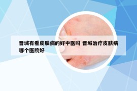 晉城有看皮膚病的好中醫(yī)嗎 晉城治療皮膚病哪個醫(yī)院好