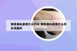 銀屑病頭部用什么藥水 銀屑病頭部用什么藥水洗最好