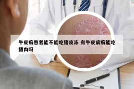 牛皮癬患者能不能吃豬皮凍 有牛皮病癬能吃豬肉嗎