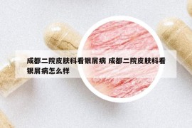成都二院皮膚科看銀屑病 成都二院皮膚科看銀屑病怎么樣