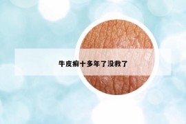 牛皮癬十多年了沒(méi)救了