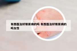 有西醫(yī)治好銀屑病的嗎 有西醫(yī)治好銀屑病的嗎女性