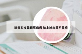 臉部脫皮是銀屑病嗎 臉上掉皮是不是癬