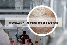 夢到別人起了一身牛皮癬 夢見身上長牛皮鮮