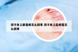 孩子身上都是癬怎么回事 孩子身上起癬是怎么回事