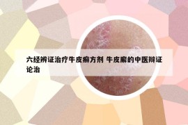 六經(jīng)辨證治療牛皮癬方劑 牛皮廨的中醫(yī)辯證論治