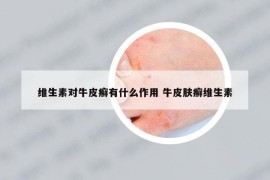 維生素對(duì)牛皮癬有什么作用 牛皮膚癬維生素