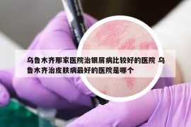 烏魯木齊那家醫(yī)院治銀屑病比較好的醫(yī)院 烏魯木齊治皮膚病最好的醫(yī)院是哪個(gè)