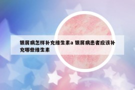 銀屑病怎樣補(bǔ)充維生素a 銀屑病患者應(yīng)該補(bǔ)充哪些維生素