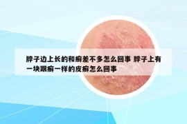 脖子邊上長(zhǎng)的和癬差不多怎么回事 脖子上有一塊跟癬一樣的皮癬怎么回事
