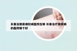 長春治銀屑病權(quán)威醫(yī)院在哪 長春治療銀屑病的醫(yī)院哪個好
