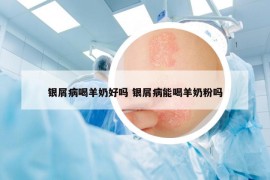 銀屑病喝羊奶好嗎 銀屑病能喝羊奶粉嗎