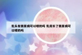 乳頭有銀屑病可以喂奶嗎 乳房長了銀屑病可以喂奶嗎