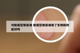 對(duì)膿皰型銀屑病 膿皰型銀屑病用了生物制劑能好嗎