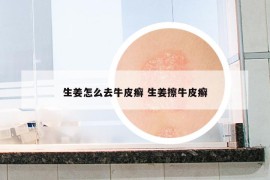 生姜怎么去牛皮癬 生姜擦牛皮癬