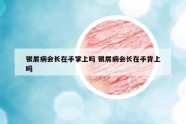 銀屑病會(huì)長(zhǎng)在手掌上嗎 銀屑病會(huì)長(zhǎng)在手背上嗎